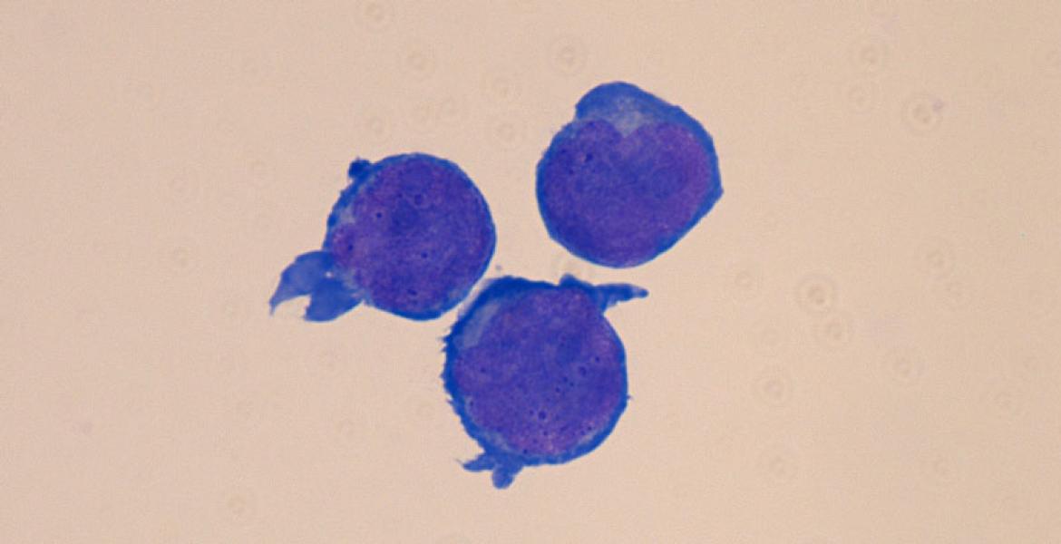 Preleukemia was initiated upon mutations in GATA1 in trisomy 21 hematopoietic stem cells 